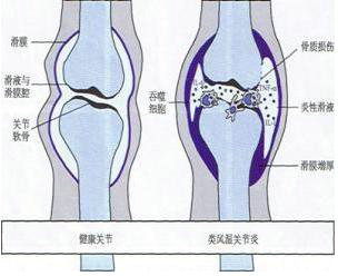 郑州痛风风湿病医院类风湿发病示意图.jpg