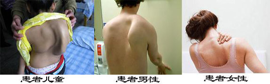 郑州痛风风湿病医院不同性别、年龄都有可能患有强直性脊柱炎.jpg