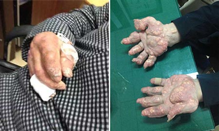 郑州痛风风湿病医院-痛风有效不治,会产生痛风石,导致关节畸形.jpg